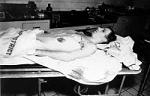 Lee Harvey Oswald's Corpse
